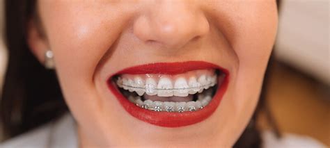 Magical Teeth Braces: The Key to a Beautiful Smile